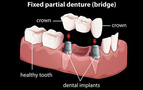 bridges-and-partial-dentures